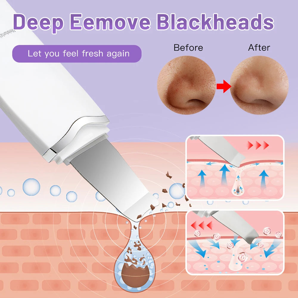Electric Ultrasonic Skin Scrubber – Facial Spatula for Blackhead Removal, Peeling & Lifting Cleansing